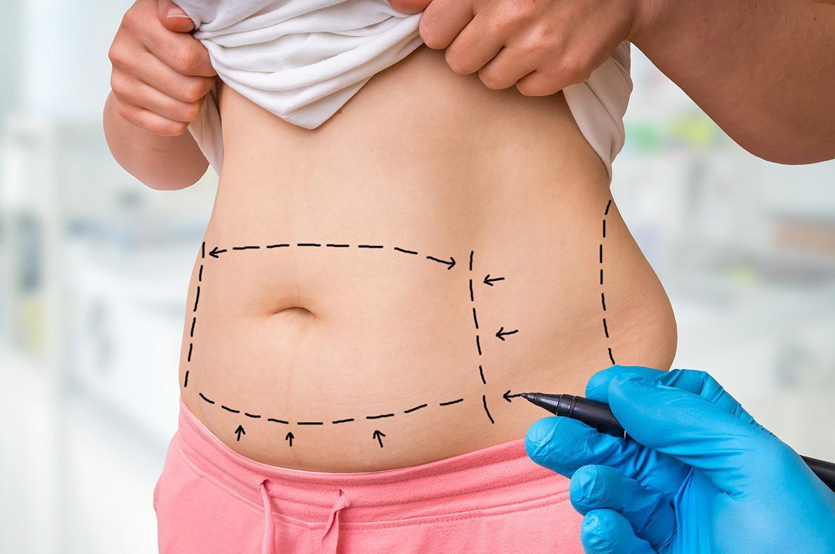 pierdere în greutate tummy tuck cicatrici pierdere în greutate mai mică
